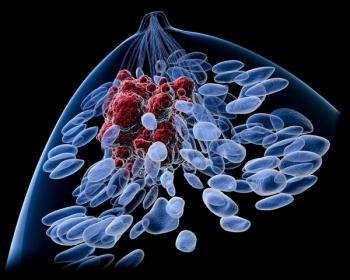 The Lurie Cancer Center Hispanic Breast Cancer Clinic taps into the efforts of Spanish-speaking physicians, social workers, and others to help treat Hispanic patients with breast cancer, says Claudia Tellez, MD.
