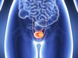 Nadofaragene Firadenovec Results in uMRD-Negative Status in NMBIC