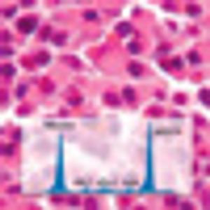 Current Diagnosis and Management of Multiple Myeloma