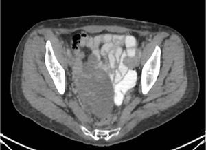 Disorders of Sex Development and Malignant Germ Cell Tumors