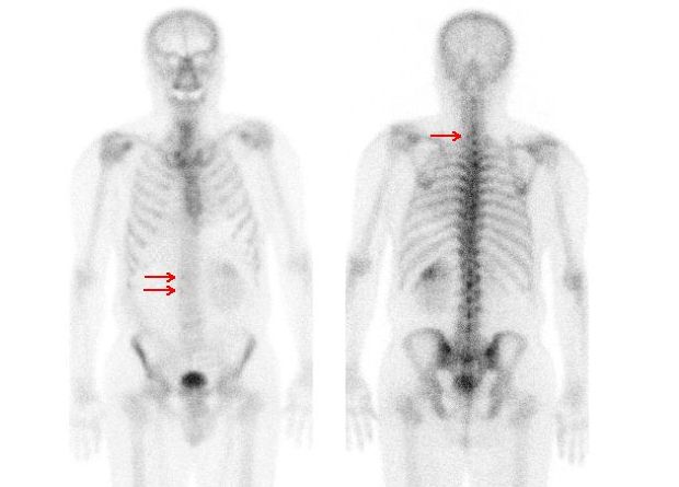 HDP whole-body bone scan of patient with renal cancer 
