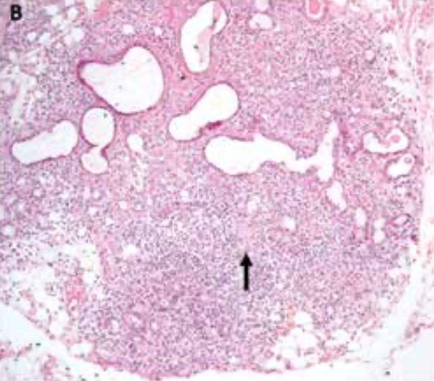 FIGURE 1. Dry Mouth Before Systemic Steroids Course (B) Histopathological examination revealed minor salivary gland with atrophy of acinar cells and ductal dilatation. Acinar structures are infiltrated by lymphocytes, plasma cells, and scattered giant cells (arrow). Collagen fibers surround with duct ectasia and inspissated luminal acidophilic clusters (HE X40). Immunohistochemical reactions in sequential sections of salivary gland