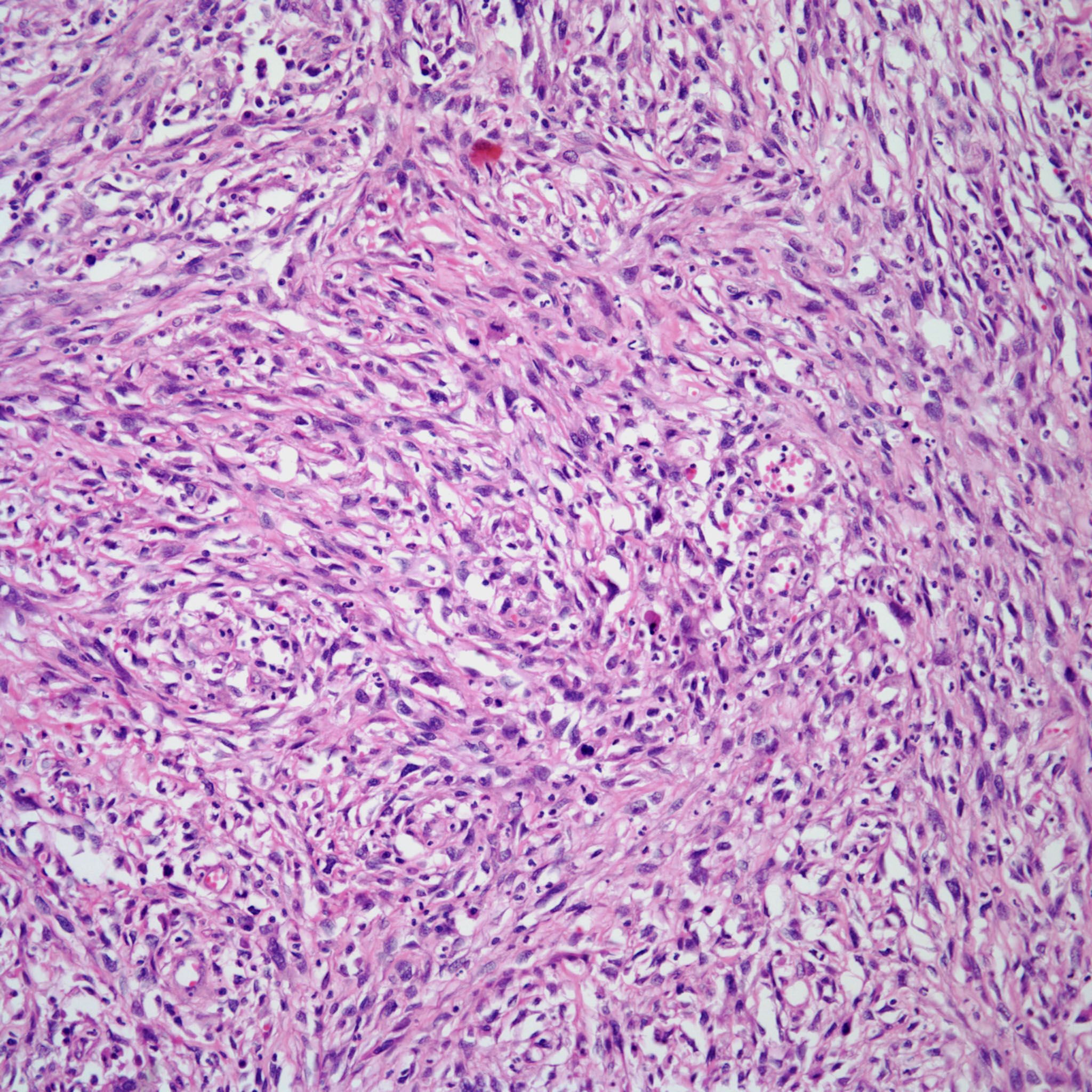 58-year-old-man-with-a-mass-in-the-larynx