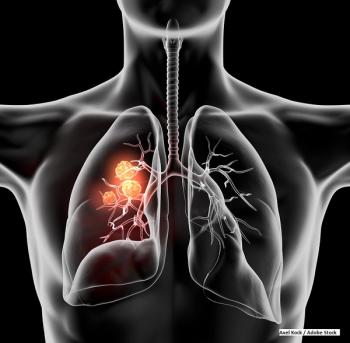 lung cancer, NSCLC