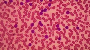 chronic lymphocytic leukemia