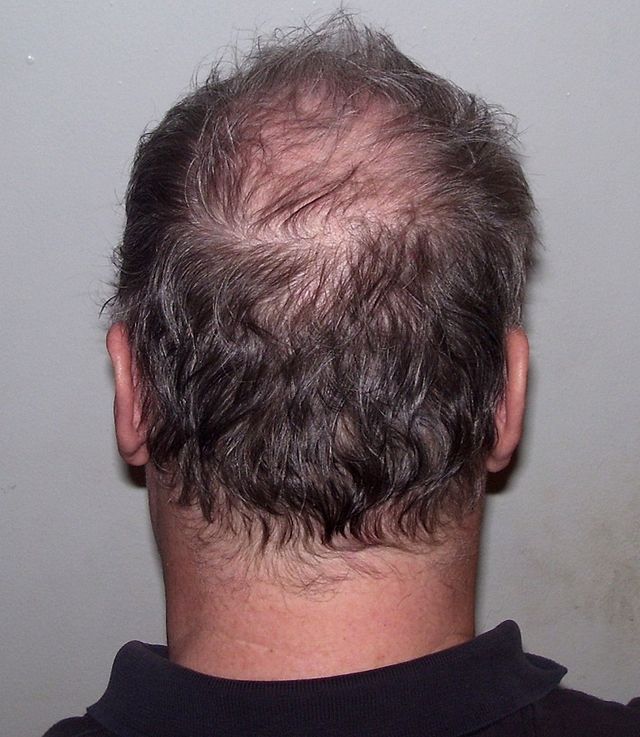 Baldness in Middle Age May Be Linked to Aggressive Prostate Cancer