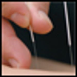 Acupuncture in Cancer Care