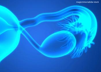 Fuzuloparib monotherapy and as a combination with apatinib improved PFS as maintenance therapy in patients with ovarian cancer harboring BRCA1/2 mutations.