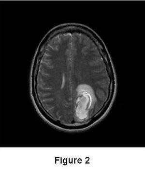 Immune-Related Adverse Events Involving Multiple Organ Sites in a Patient Treated With Nivolumab Plus Ipilimumab
