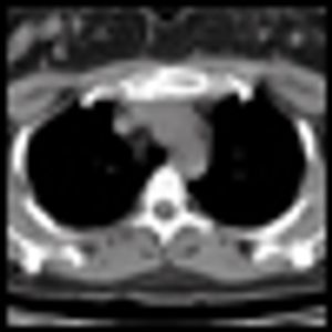 A Woman With Primary Breast Cancer and a Solitary Sternal Metastasis