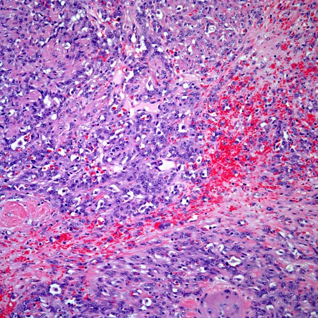 Among patients with low-grade, non–muscle invasive bladder cancer, intravesical UGN-102 appears to improve outcomes vs standard surgical treatment in two phase 3 trials.