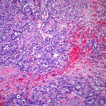 Investigators note that the phase 3 VESPER study’s data support the use of 6 neoadjuvant cycles of dose-dense MVAC vs 4 in muscle-invasive bladder cancer.