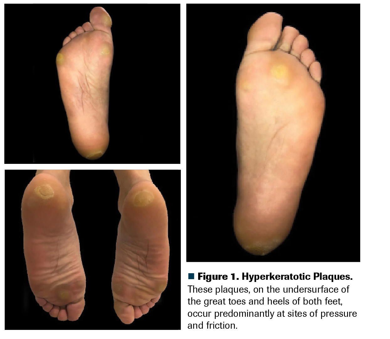 Figure 1. Hyperkeratotic Plaques. These plaques, on the undersurface of the great toes and heels of both feet, occur predominantly at sites of pressure and friction.