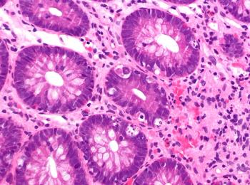 An experimental cyclophosphamide-based prophylaxis regimen may also elicit a lower rate of chronic graft-versus-host-disease vs standard prophylaxis in patients with hematologic cancers.