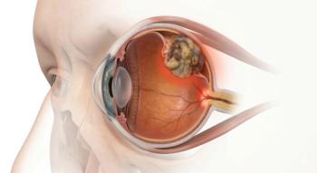 Medical visualization of primary Ocular Melanoma (uveal melanoma) showing nodular, non-homogeneous, infiltrative tumor mass arising from the choroid, clinical ophthalmology and oncology illustration: © Maryia - stock.adobe.com