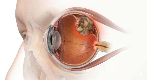 Medical visualization of primary Ocular Melanoma (uveal melanoma) showing nodular, non-homogeneous, infiltrative tumor mass arising from the choroid, clinical ophthalmology and oncology illustration: © Maryia - stock.adobe.com