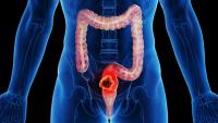 Dostarlimab Yields Complete Responses in dMMR/MSI-H Rectal Cancer: © Sebastian Kaulitzki - stock.adobe.com