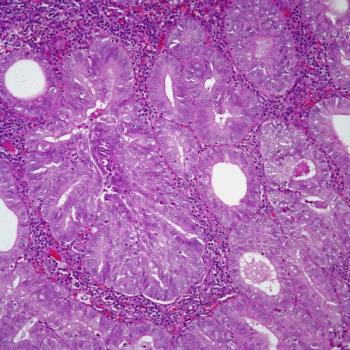 Data from the phase 3 KEYNOTE-775 trial support lenvatinib plus pembrolizumab as a standard therapy option for patients with previously treated advanced endometrial cancer.