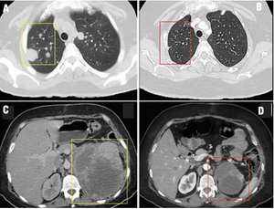 Metastatic Renal Cell Carcinoma With Sarcomatoid Features
