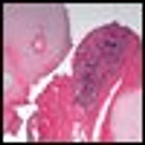 Retroperitoneal Neuroblastoma Causing Urinary Obstruction in a 5-Month-Old Boy