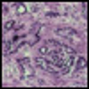 Costly Prostate Cancer Vaccine-Provenge-Likely to Be Covered by Medicare