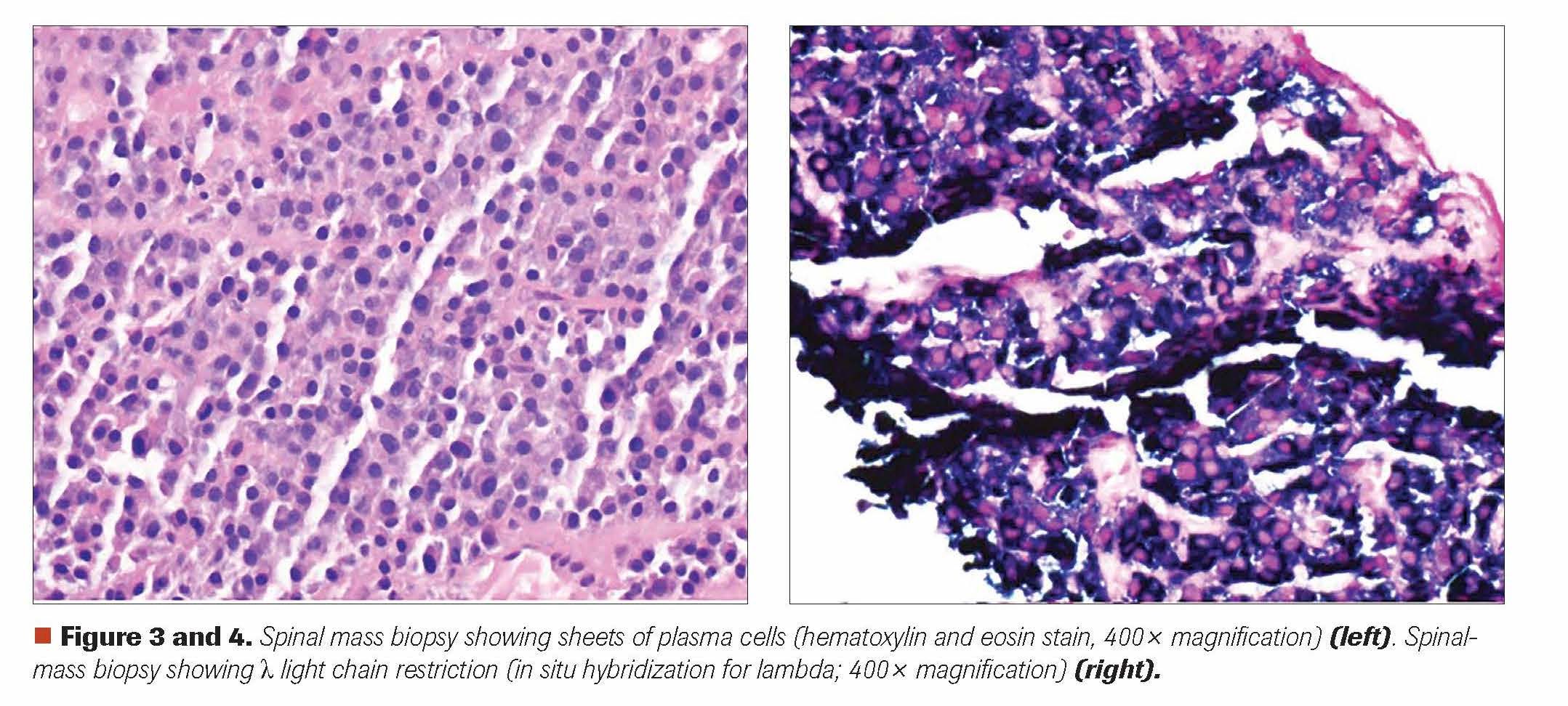 Figure 3 and 4. Spinal mass biopsy showing sheets of plasma cells (hematoxylin and eosin stain, 400x magnification) (left). Spinalmass biopsy showing λ light chain restriction (in situ hybridization for lambda; 400x magnification) (right).