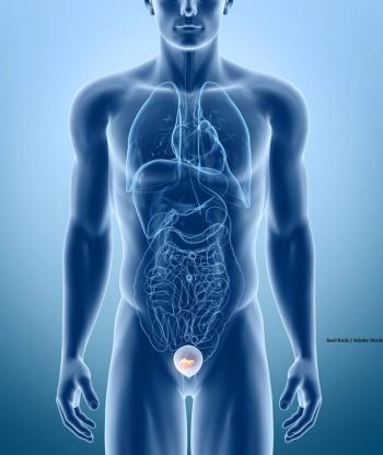 Investigators assessed the long-term outcomes of neoadjuvant chemotherapy plus chemoradiation in those with non-metastatic muscle-invasive bladder cancer.
