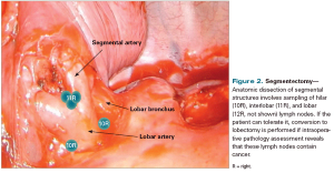 Minimally Invasive Surgery for Early-Stage Lung Cancer: From Innovation to Standard of Care