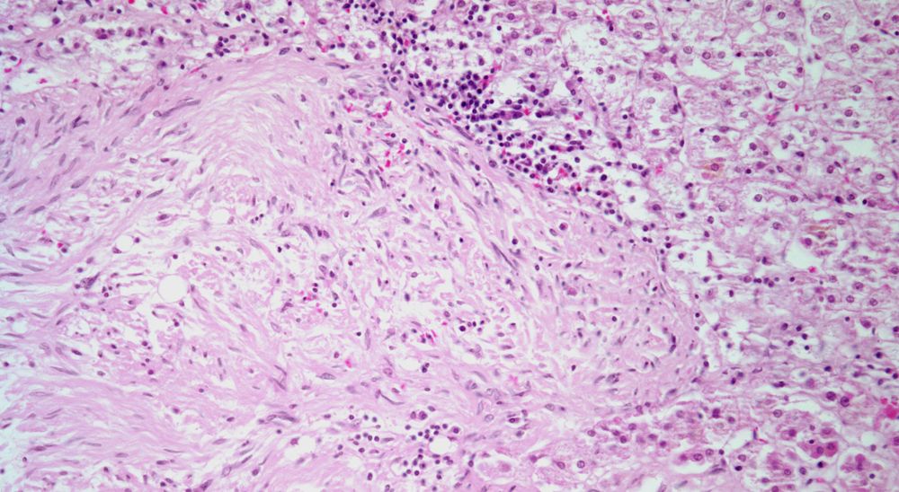 Patient Presents With Adrenal Gland Nodule