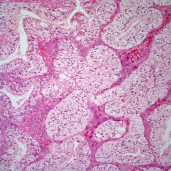 A progression-free survival benefit was seen in those with TP53 wild-type advanced/recurrent endometrial cancer who were treated with selinexor maintenance regardless of microsatellite instability status.
