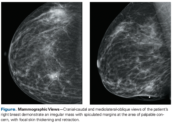 A 35-Year-Old Woman With a Change in HER2 Expression