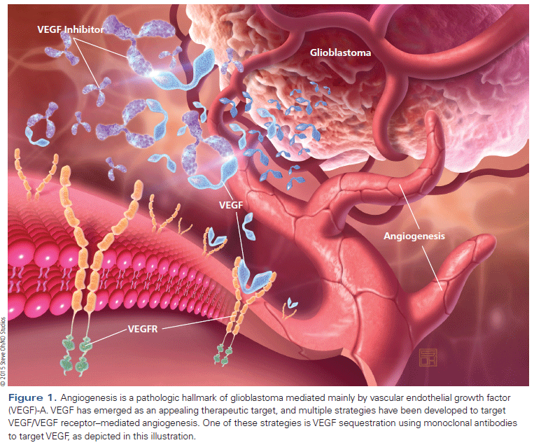 VEGF Manipulation in Glioblastoma | CancerNetwork VEGF Manipulation in Glioblastoma | CancerNetwork