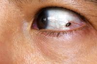 Mole in woman eye. Ocular melanoma in the eye: © Maliflower73 - stock.adobe.com