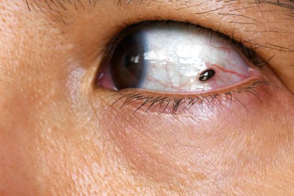 Mole in woman eye. Ocular melanoma in the eye: © Maliflower73 - stock.adobe.com