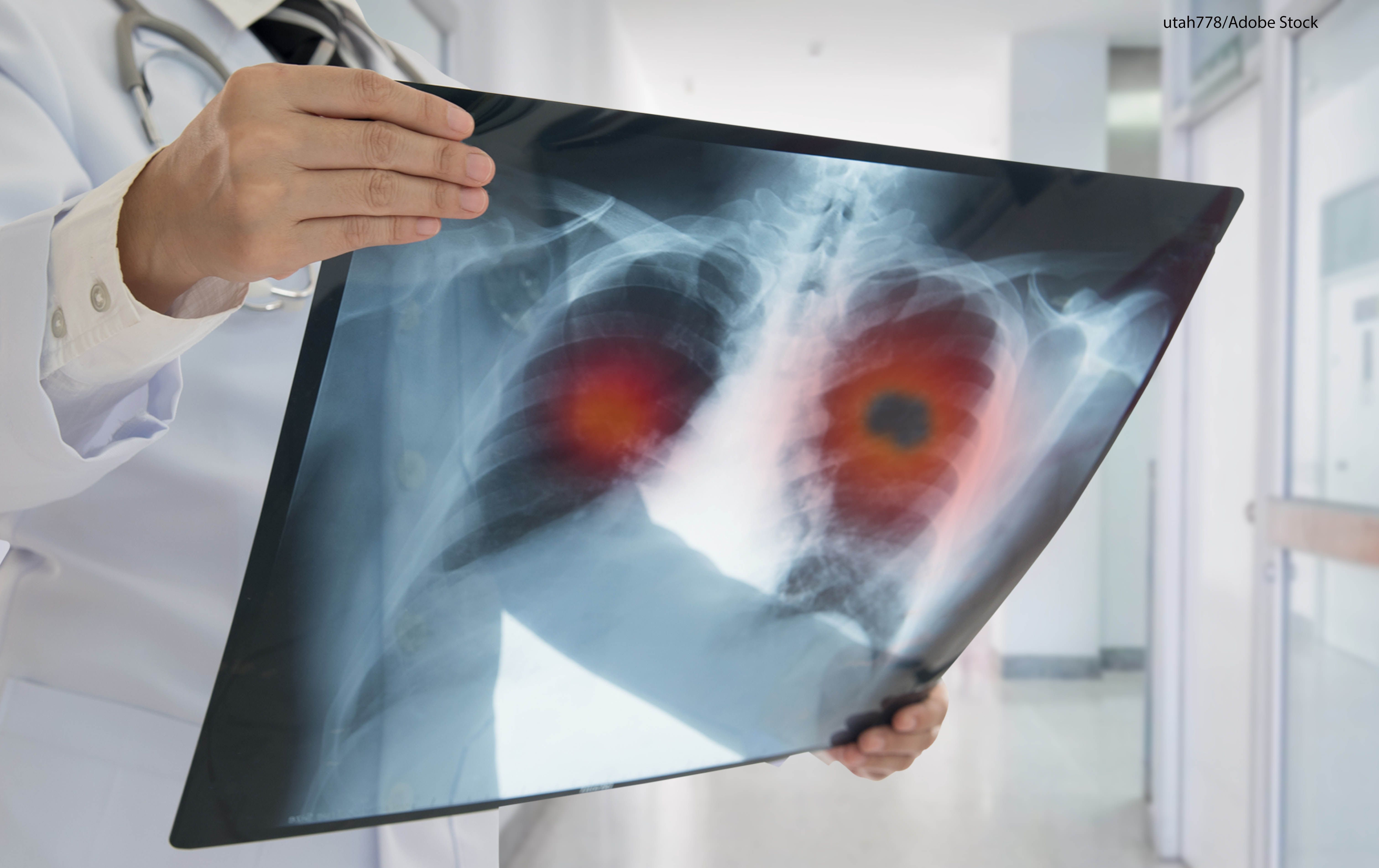 Despite gaps in biomarker testing accessibility, the lung cancer survival rate has improved by 26% over the last 5 years.