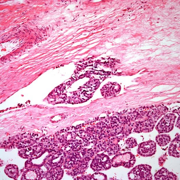 Slide Show: Follicular Thyroid Carcinoma and Hurthle Cell Cancer ...