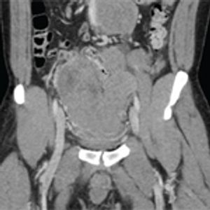 Large Scrotal Mass With Multifocal Intra-Abdominal, Retroperitoneal, and Pelvic Metastases