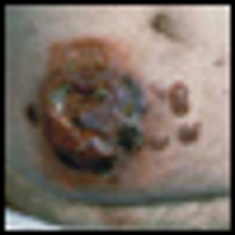 Diagnosis And Management Of Mycosis Fungoides