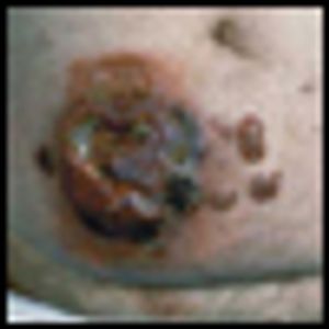 Diagnosis and Management of Mycosis Fungoides