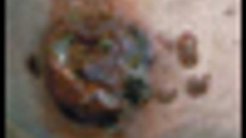 Diagnosis And Management Of Mycosis Fungoides Diagnosis And Management Of Mycosis Fungoides