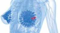 Imlunestrant Combo Will Not Be Pursued for FDA Approval in Breast Cancer