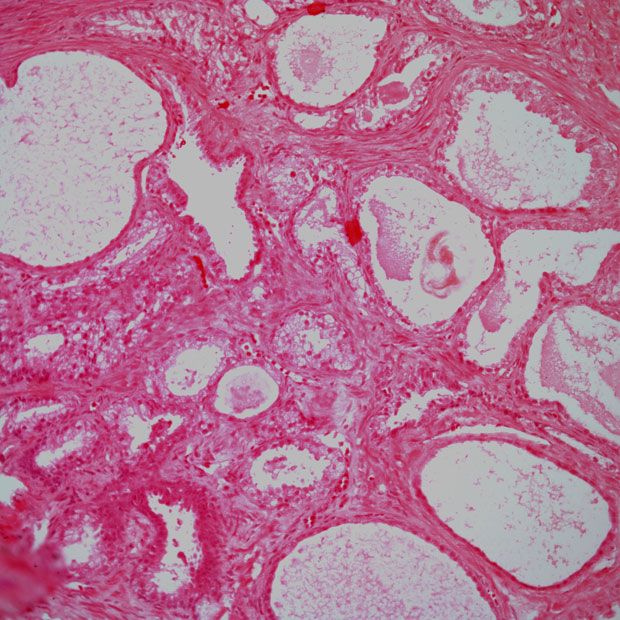 Combination treatment with cabozantinib and atezolizumab did not produce any new safety signals in the treatment of those with metastatic castration-resistant prostate cancer in the phase 3 CONTACT-02 trial.