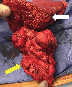 Location, Location, Location: Approaches to Retroperitoneal Vascular Leiomyosarcoma