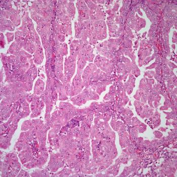 The phase 3 RUBY trial of dostarlimab plus carboplatin and paclitaxel significantly improved progression-free survival in patients with dMMR/MSI-H or MMRp/MSS endometrial cancer.