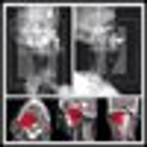 The Multidisciplinary Management of Paragangliomas of the Head and Neck, Part 2