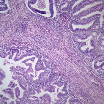 Durvalumab plus tremelimumab and hypofractionated radiotherapy yields observable clinical benefits in patients with gynecologic cancers, according to an expert from The University of Texas MD Anderson Cancer Center.