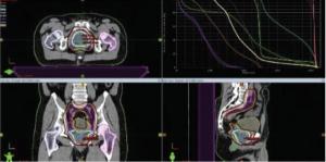 The Role of Primary Tumor Treatment and Metastasis-Directed Therapy in Oligometastatic Prostate Cancer