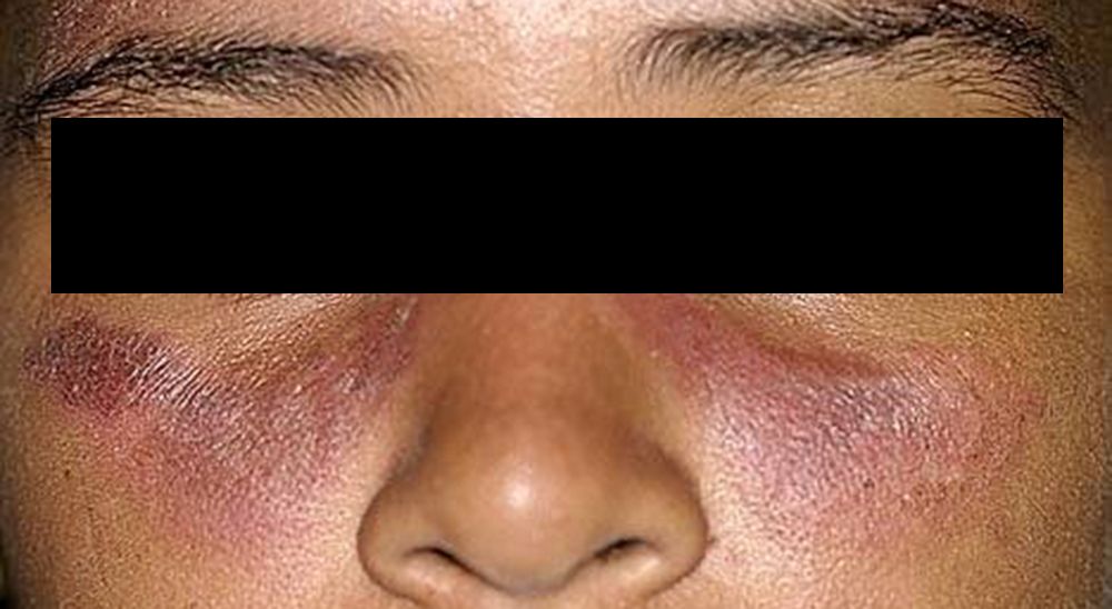 Photosensitive Skin Rash Photosensitive Facial Rash Depicted Along with Polyarticular Arthralgias