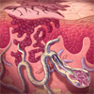 Isolated Limb Perfusion for Stage III Melanoma: Does It Still Have a Role in the Present Era of Effective Systemic Therapy?