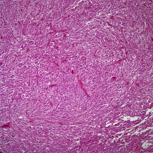 Data from a phase 2 trial assessing lenalidomide in patients under 22 years of age also highlight an optimal dose level for this population.